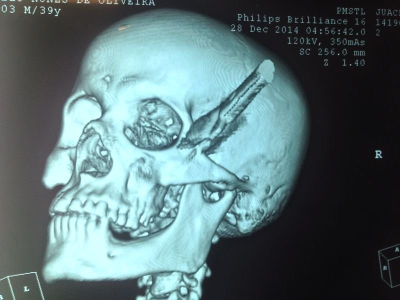 Man Survives Knife Stuck in Head